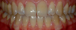 Teeth Whitening step1