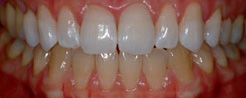 Teeth Whitening step2