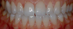 Teeth Whitening step3