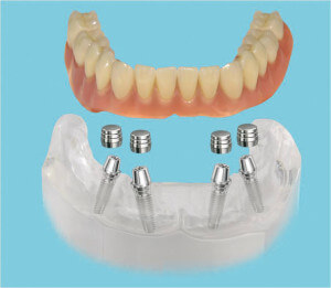 Dental Implants 02
