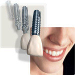 Dental Implants Edited