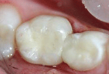 Teeth Fillings 02