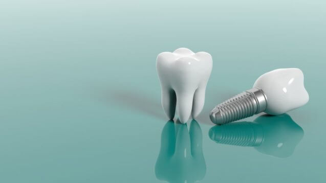 All About Immediate Dental Implants
