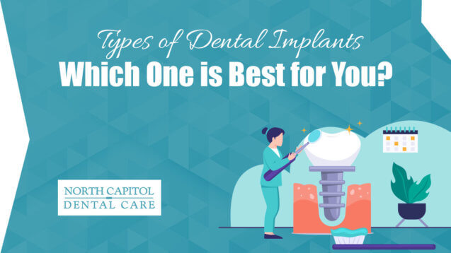 Types of Dental Implants! Know which One Is Best for You?