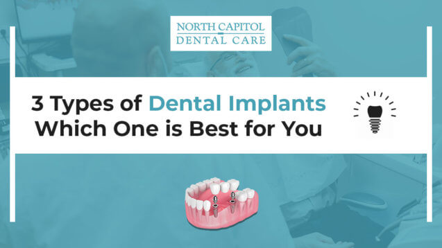 3 Types of Dental Implants (Which One Is Best for You)?
