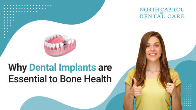 Why Dental Implants Are Essential To Bone Health