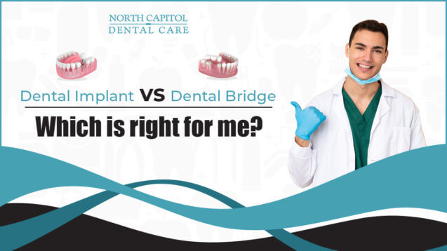 Dental Implant vs. Dental Bridge: Which Is Right For Me?